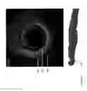 Fig. 24 - Identification of elastic lamina to guide interventional therapy