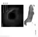 Fig. 25 - Identification of elastic lamina to guide interventional therapy