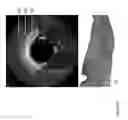 Fig. 26 - Identification of elastic lamina to guide interventional therapy