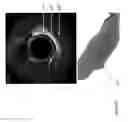Fig. 27 - Identification of elastic lamina to guide interventional therapy