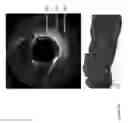 Fig. 28 - Identification of elastic lamina to guide interventional therapy