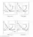 Fig. 17 - Devices and methods for tissue access