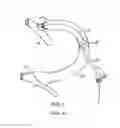 Fig. 02 - TEMPORARY VASCULAR SCAFFOLD AND SCORING DEVICE