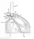 Fig. 01 - Method for placing a cannula in a bladder