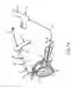 Fig. 18 - Method for placing a cannula in a bladder