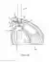 Fig. 22 - Method for placing a cannula in a bladder