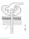 Fig. 11 - Expandable percutaneous sheath