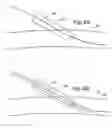 Fig. 05 - Transradial access devices, systems, and methods