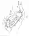 Fig. 07 - Intrauterine balloon apparatus, system, and method for augmenting uterine birthing forces during parturition