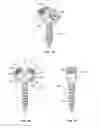 Fig. 08 - GROWING SPINAL RODS AND PEDICLE SCREWS FOR SECURING MULTIPLE SPINAL RODS