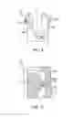 Fig. 11 - Locking compression members for use with bone anchor assemblies and methods