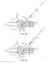 Fig. 11 - Facet screw and method for spinal stabilization