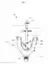 Fig. 08 - Curved tibiotalar fusion nail and method of use
