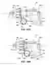 Fig. 17 - Energy delivery device having a translating outer sheath