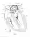 Fig. 02 - Intra-cardiac mapping and ablating