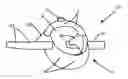 Fig. 01 - GLOTTO-MANDIBULAR ARCHES DEVICE FOR TMJ DISEASE