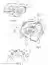 Fig. 03 - GLOTTO-MANDIBULAR ARCHES DEVICE FOR TMJ DISEASE