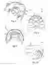 Fig. 04 - GLOTTO-MANDIBULAR ARCHES DEVICE FOR TMJ DISEASE