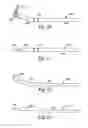Fig. 05 - INTERARCH FORCE MODULE WITH LINK FOR ORTHODONTIC TREATMENT