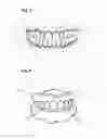 Fig. 03 - Apparatus and methods of making denture devices