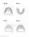 Fig. 05 - Apparatus and methods of making denture devices
