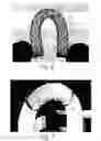 Fig. 05 - Metallic implantable grafts and method of making same