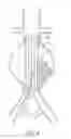 Fig. 10 - Devices and methods for treatment of vascular aneurysms