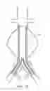 Fig. 15 - Devices and methods for treatment of vascular aneurysms