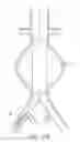 Fig. 27 - Devices and methods for treatment of vascular aneurysms