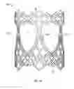 Fig. 02 - Collapsible prosthetic heart valves