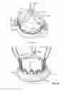 Fig. 56 - Collapsible prosthetic heart valves