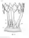 Fig. 64 - Collapsible prosthetic heart valves