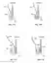 Fig. 68 - Collapsible prosthetic heart valves