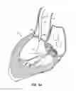 Fig. 08 - Low profile heart valve and delivery system