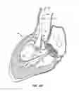 Fig. 09 - Low profile heart valve and delivery system