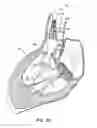 Fig. 10 - Low profile heart valve and delivery system