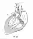 Fig. 11 - Low profile heart valve and delivery system