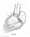 Fig. 13 - Low profile heart valve and delivery system