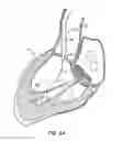 Fig. 14 - Low profile heart valve and delivery system