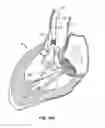 Fig. 15 - Low profile heart valve and delivery system