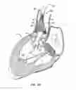 Fig. 16 - Low profile heart valve and delivery system