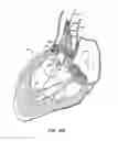 Fig. 17 - Low profile heart valve and delivery system