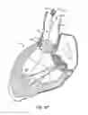 Fig. 19 - Low profile heart valve and delivery system