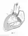 Fig. 20 - Low profile heart valve and delivery system