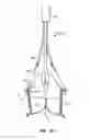 Fig. 22 - Low profile heart valve and delivery system