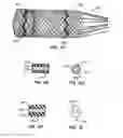 Fig. 38 - Low profile heart valve and delivery system