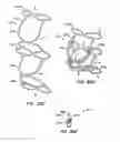 Fig. 45 - Low profile heart valve and delivery system
