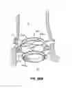 Fig. 49 - Low profile heart valve and delivery system