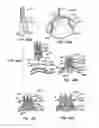 Fig. 52 - Low profile heart valve and delivery system