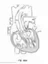 Fig. 54 - Low profile heart valve and delivery system